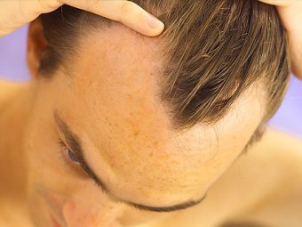 Причины выпадения волос у мужчин и их научное обоснование
