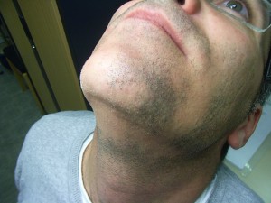 Алопеция на бороде у мужчин